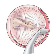 Steps for Stap Surgery