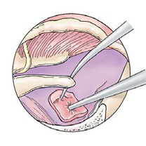 Steps for Stap Surgery