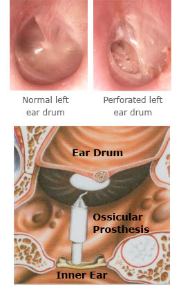 ear_drum_perforations