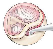 Steps for Stap Surgery