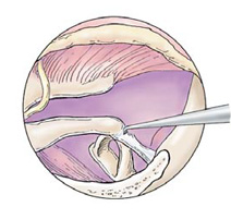 Steps for Stap Surgery