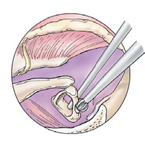 Steps for Stap Surgery