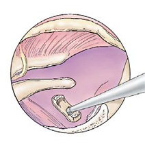 Steps for Stap Surgery
