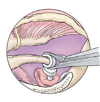 Steps for Stap Surgery