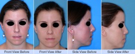 Nasal Fracture