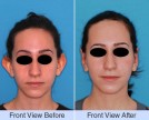 Otoplasty