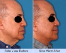 Submentoplasty