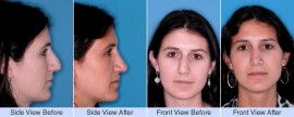 Asymmetric, droopy nose