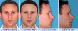 Asymmetric over projected nose