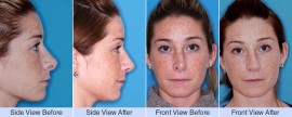 Revision rhinoplasty