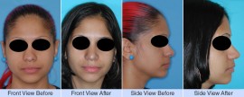 Asymmetric, droopy nose