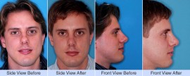 Overprojected, rotated nose