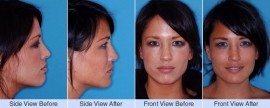 Deviated, nasal valve collapse