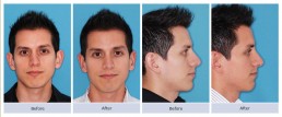 Overprojected, asymmetric ears