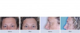 Sagging upper and lower lids