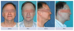 Submentoplasty - Neck Skin Laxity