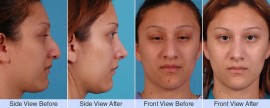 Bump, droopy nose