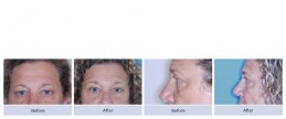 Sagging upper and lower lids