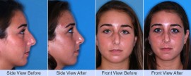 Asymmetric nose, bump