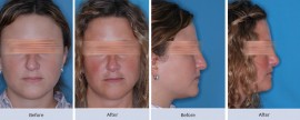 Asymmetric, droopy nose