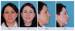 Revision rhinoplasty and nasal valve repair for scooped out bridge and overly rotated tip