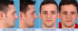 Asymmetric, droopy, bump nose