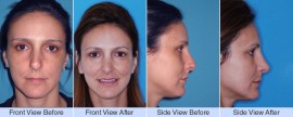Revision rhinoplasty