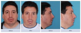 Revision rhinoplasty and nasal valve repair on twisted nose with a droopy tip