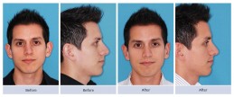 Deviated nose, small hump