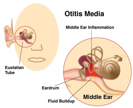 Mastoiditis treatment