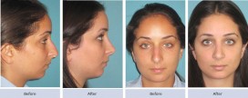 dorsal hump, droopy tip, nasal valve collapse