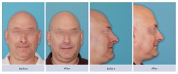 Revision rhinoplasty and nasal valve repair on twisted nose with a droopy tip