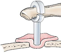 Steps for Stap Surgery