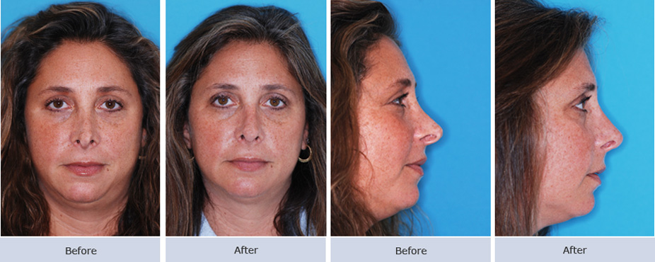 Nasal Valve Reconstruction Photos | Cosmetic Surgery NYC