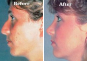 nose surgery before and after nose surgery before and after